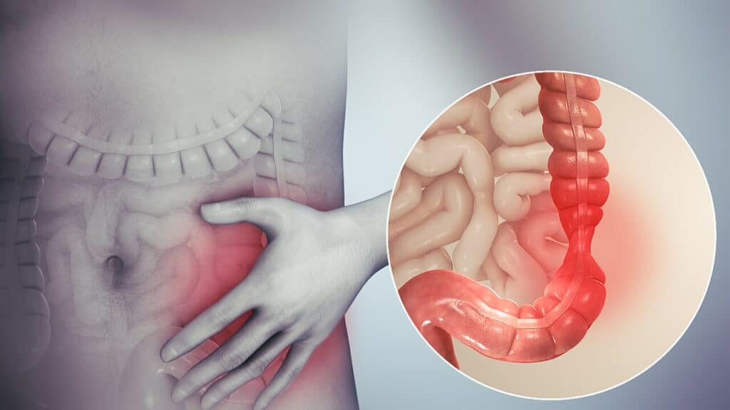 When Salmonella Doesn’t Really Leave: Understanding Latent Infection and Secondary Complications When Salmonella Doesn’t Really Leave: Understanding Latent Infection and Secondary Complications